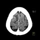 Hemorrhage in brain metastasis, perifocal edema - follow-up after 6 months: CT - Computed tomography